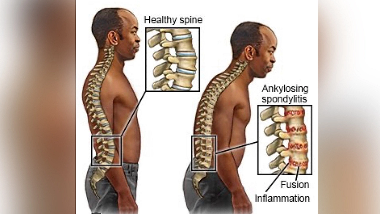 Ankilozan Spondilitte egzersiz ve sigarasız yaşam uyarısı