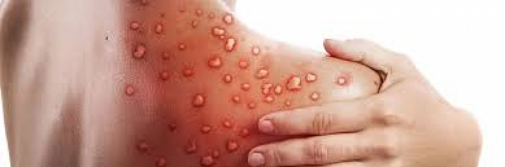 Türkiye için kritik günler: bir ülke daha vaka bildirdi!