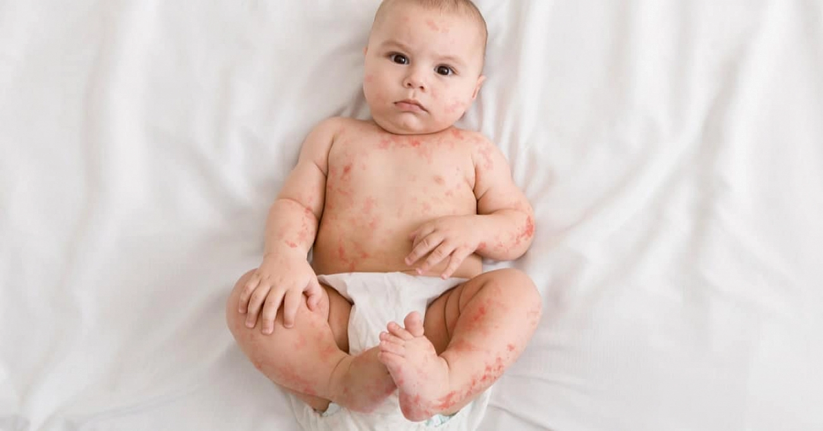 Elazığlı Ebeveynler Dikkat! Bebeklerinizde Bu Belirtiler Varsa Mutlaka Hastaneye Gidin!