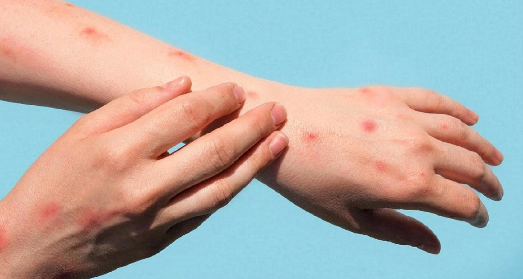 Maymun Çiçeği Uyarısı!