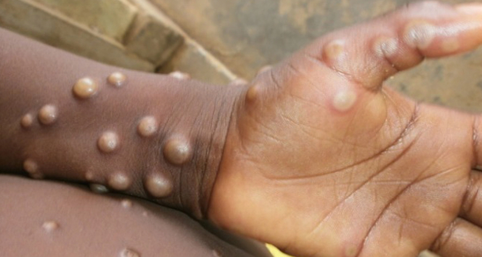 Maymun Çiçeği Uyarısı!