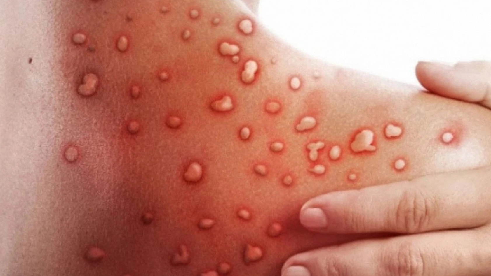 Maymun çiçeği bilgilendirmesi geldi: İşte tüm merak edilenler!