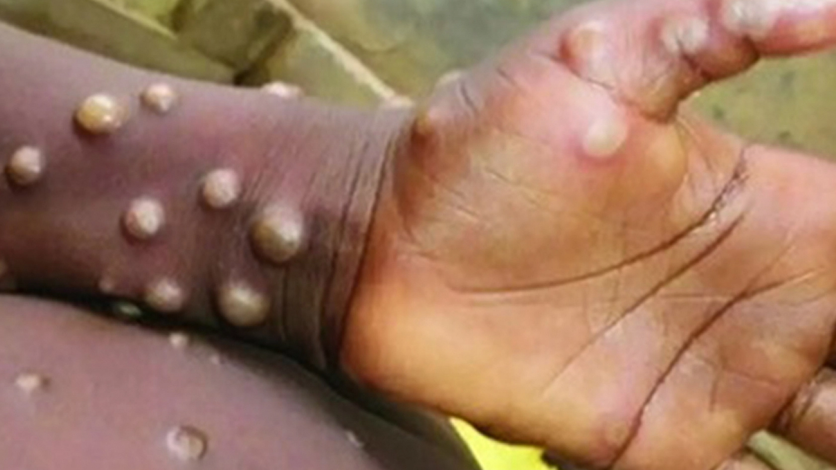 Maymun çiçeği bilgilendirmesi geldi: İşte tüm merak edilenler!