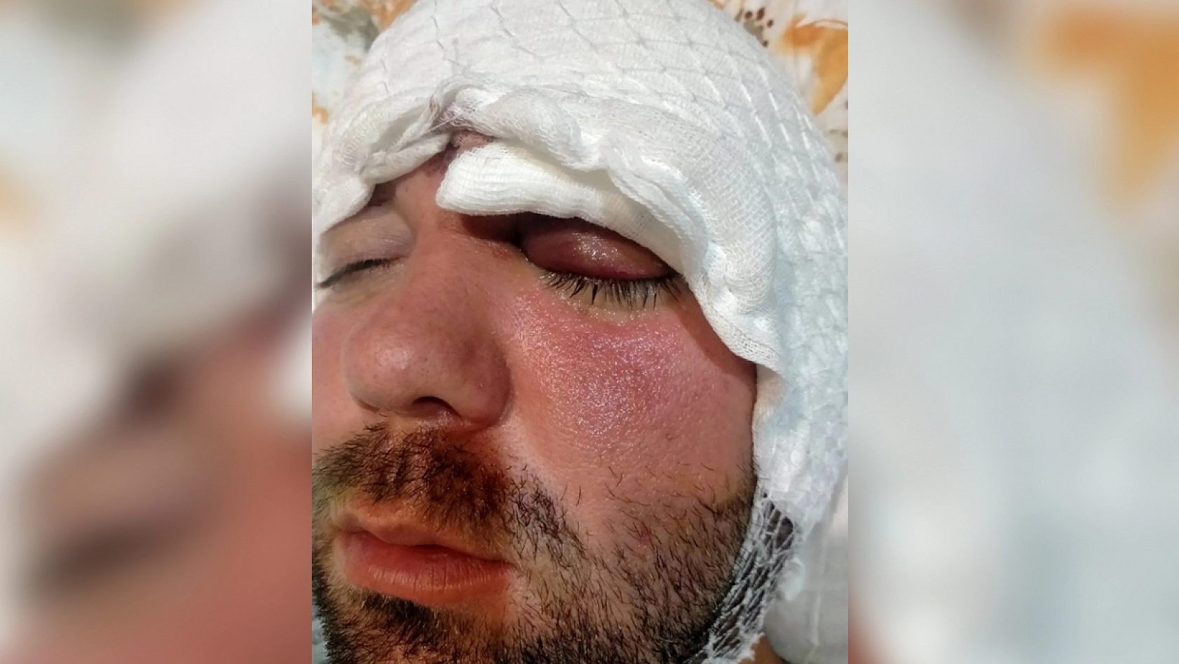 Diş tedavisi felakete dönüştü: İmplant vidası kafatasına saplandı