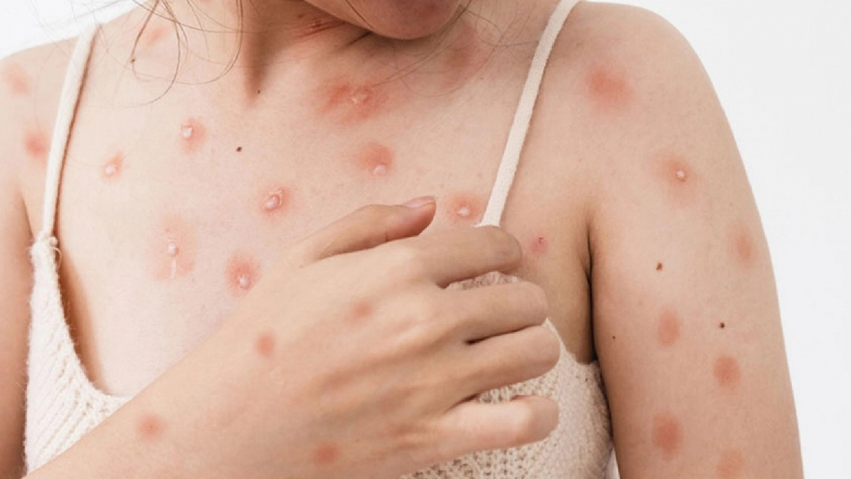 Maymun çiçeği bilgilendirmesi geldi: İşte tüm merak edilenler!