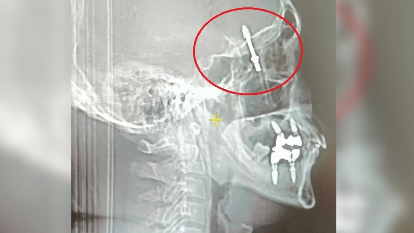 Diş tedavisi felakete dönüştü: İmplant vidası kafatasına saplandı