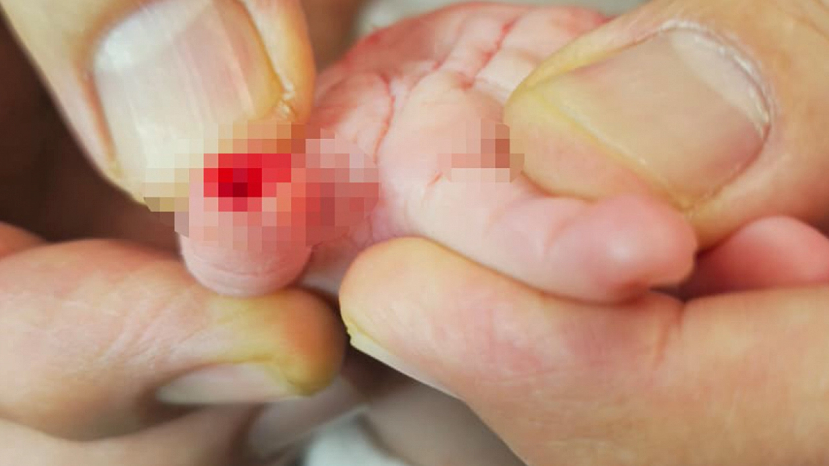 5 aylık bebeğin parmağı serum çıkarılırken koptu