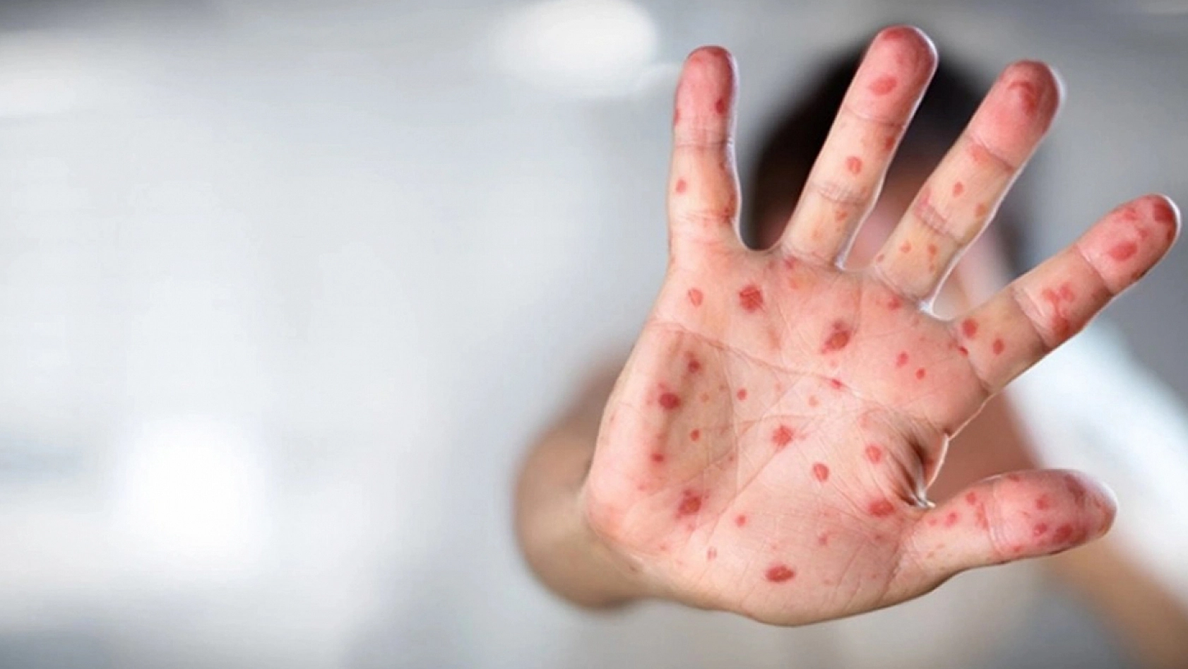 Maymun çiçeği bilgilendirmesi geldi: İşte tüm merak edilenler!