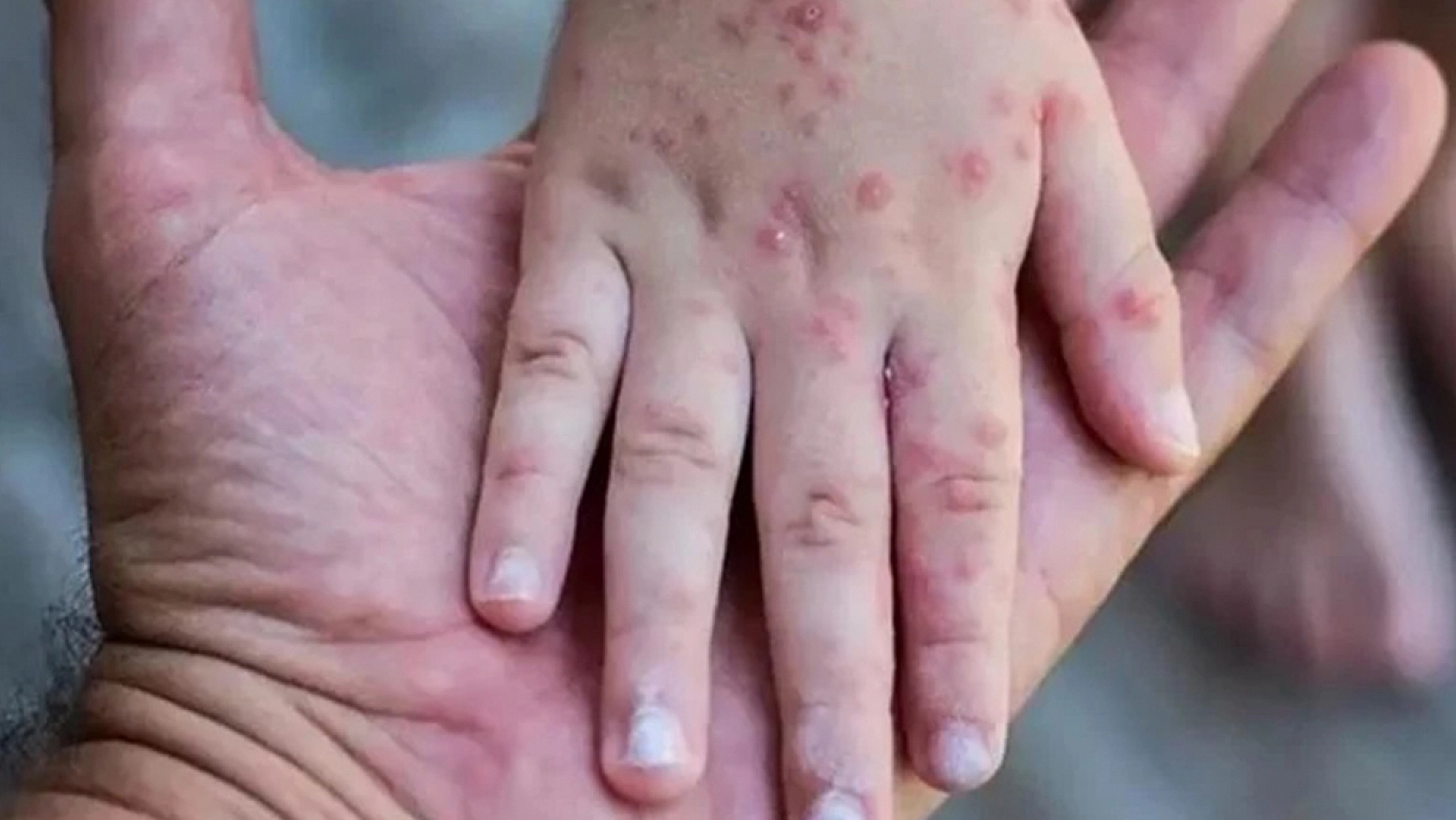 Maymun çiçeği bilgilendirmesi geldi: İşte tüm merak edilenler!