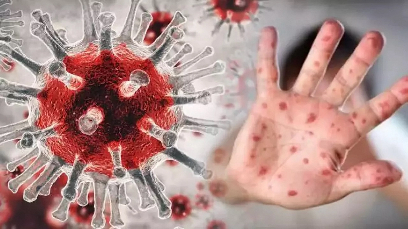 Maymun Çiçeği Uyarısı!