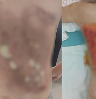 12 yaşındaki çocuğun sırtına kolonya döküp yaktılar