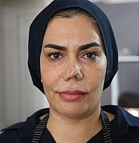Elazığ'da 4 burun ameliyat sonrası hayatı kabusa döndü