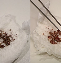 Elazığ'da doktorları bile şaşırtan vaka: Burun içinden taş çıkarıldı