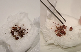 Elazığ'da doktorları bile şaşırtan vaka: Burun içinden taş çıkarıldı