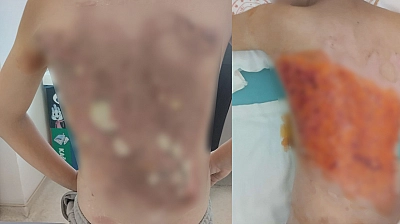 12 yaşındaki çocuğun sırtına kolonya döküp yaktılar