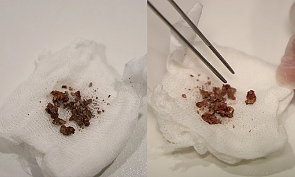 Elazığ'da doktorları bile şaşırtan vaka: Burun içinden taş çıkarıldı