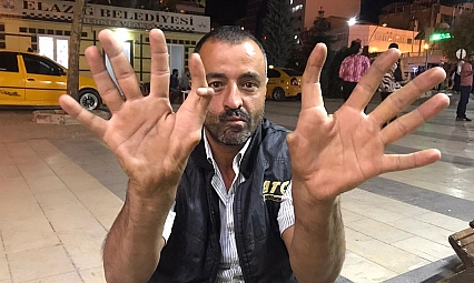 Elazığ'da 6 parmaklı kişi görenleri hayrete düşürüyor