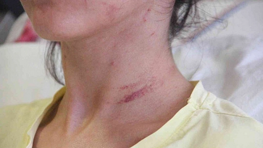 Doktor sevgilisinin evinde dehşeti yaşayan genç kadın 2 saat boyunca darp edildi, 5 yerinden bıçaklandı