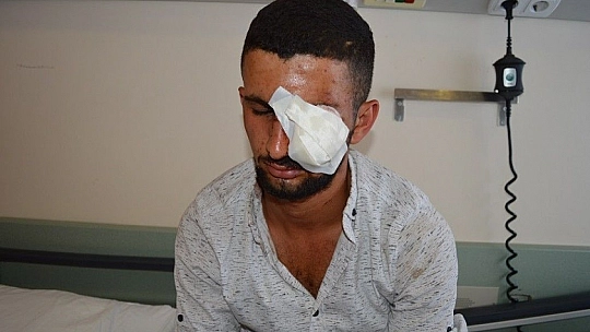 Buldukları havai fişek, sol gözüne mal oldu
