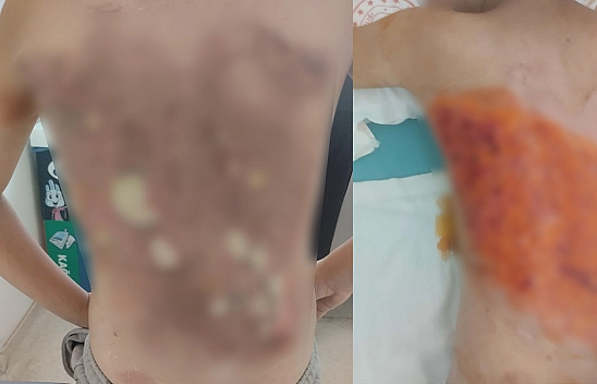 12 yaşındaki çocuğun sırtına kolonya döküp yaktılar