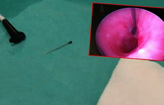 3 santimlik toplu iğne yutan çocuk, başarılı bir operasyonla sağlığına kavuştu