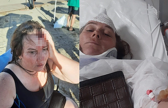 Denizde Yüzerken Jet Ski Çarptı, Ölümden Döndü