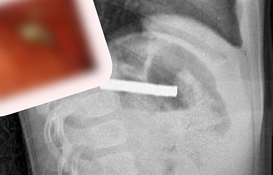 Elazığ'da 3 yaşındaki çocuğun midesinden çıkanlar şok etti