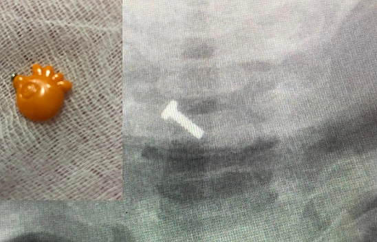 Elazığ'da 9 Aylık Bebeğin Boğazına Kaçan Yabancı Cisim Başarı İle Çıkartıldı