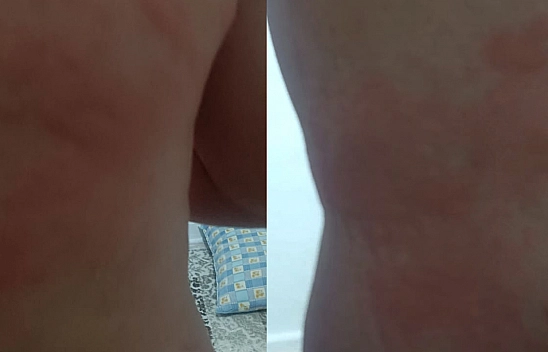 Elazığ'da böcek ısırığı hastanelik etti, vücudunda yaralar çıktı