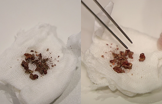 Elazığ'da doktorları bile şaşırtan vaka: Burun içinden taş çıkarıldı