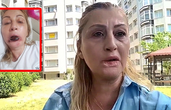 Estetik faciası: Güzelleşmek isterken dudağını kaybetti