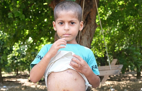 Köpeklerin Saldırdığı Çocuk 18 Gün Sonra Taburcu Oldu