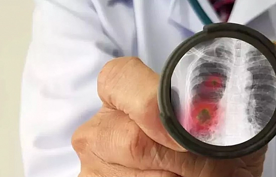 Zatürre Hastalığında Kritik Belirtilere Dikkat!