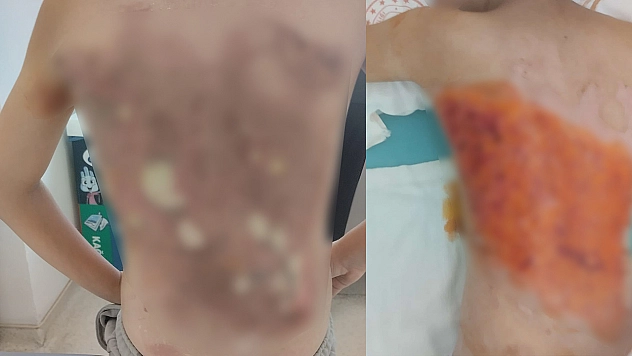 12 yaşındaki çocuğun sırtına kolonya döküp yaktılar