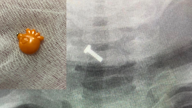 Elazığ'da 9 Aylık Bebeğin Boğazına Kaçan Yabancı Cisim Başarı İle Çıkartıldı