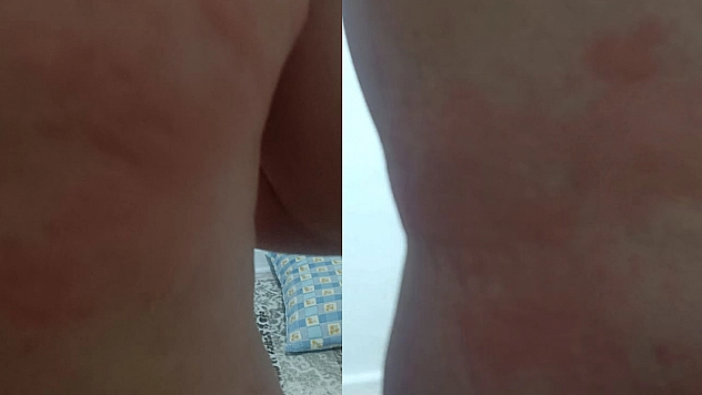 Elazığ'da böcek ısırığı hastanelik etti, vücudunda yaralar çıktı