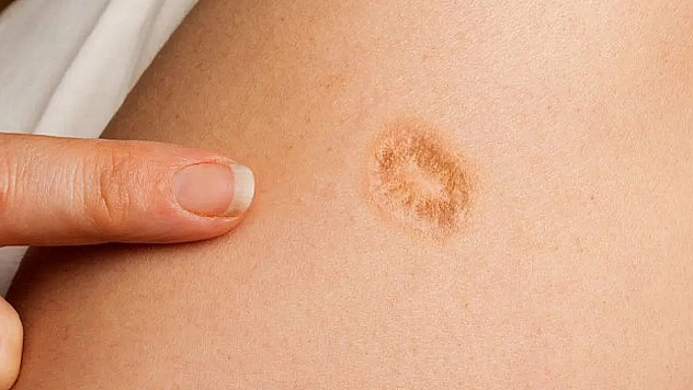 Elazığlılar, Kolunuzda Bu İz Varsa Dikkat