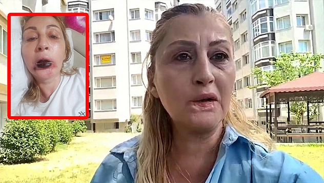 Estetik faciası: Güzelleşmek isterken dudağını kaybetti