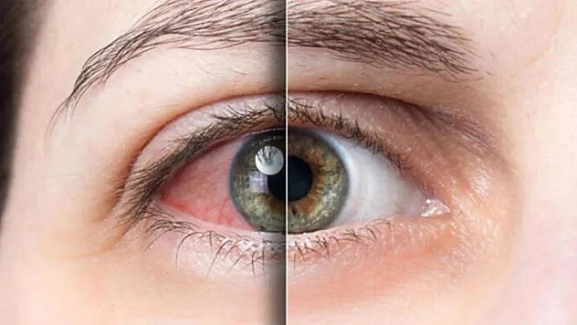 Gözleri Bahar Alerjisinden Korumanın 8 Yolu