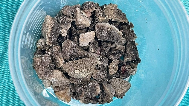 Kapalı yöntemle çıkarılan 8 cm'lik dev böbrek taşı şaşırttı