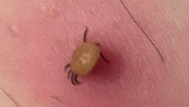 Kene ısırığı belirtisiz başlar, hızla ağırlaşabilir