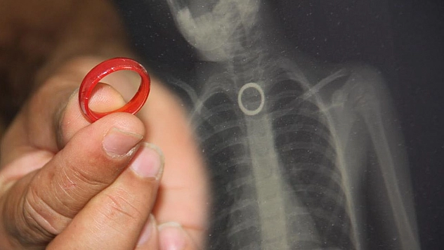 Oyun oynarken yerdeki yüzüğü yutan 3 yaşındaki çocuk ölümden döndü