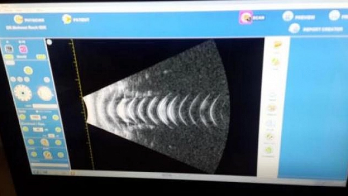 A/B Scan Ultrasound Cihazı Hizmette Sunuldu