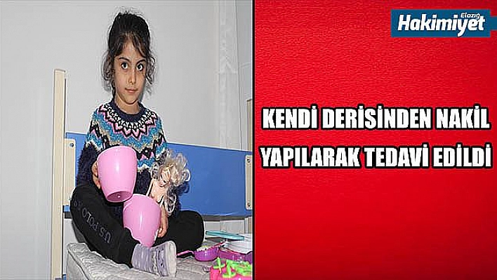 Depremde yanmıştı, küçük kız yapay ve kendi derisinin nakli ile tedavi edildi