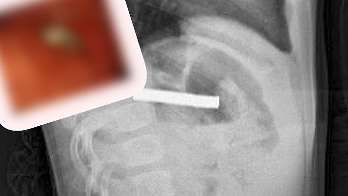 Elazığ'da 3 yaşındaki çocuğun midesinden çıkanlar şok etti