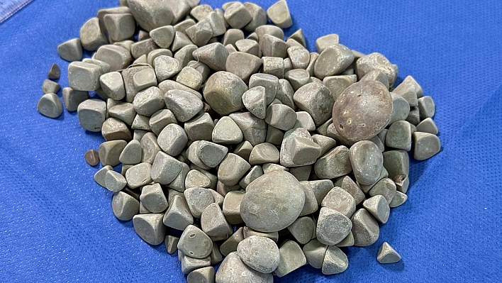 Vücudundan 287 tane taş çıkarıldı, doktorlar bile şok oldu