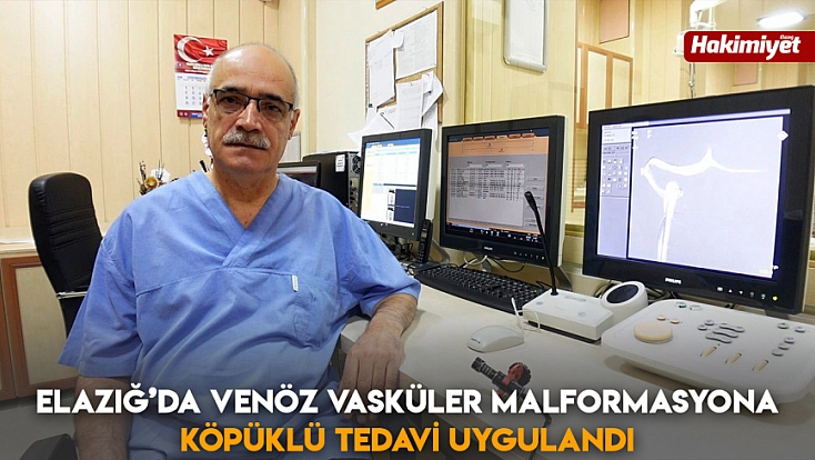 Elazığ’da Venöz Vasküler Malformasyona Köpüklü tedavi uygulandı
