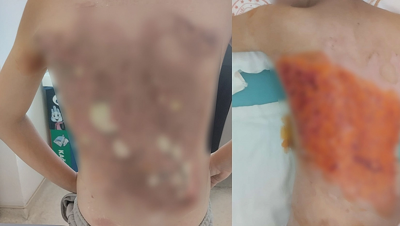 12 yaşındaki çocuğun sırtına kolonya döküp yaktılar