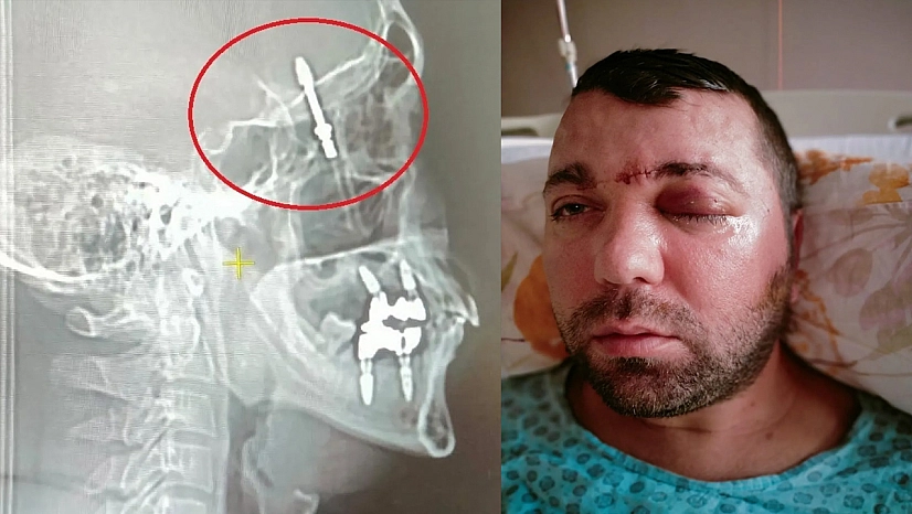 Diş tedavisi felakete dönüştü: İmplant vidası kafatasına saplandı