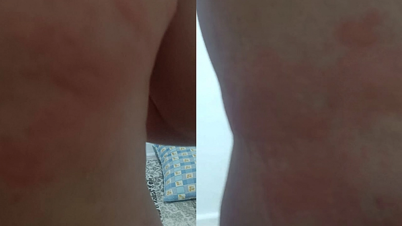 Elazığ'da böcek ısırığı hastanelik etti, vücudunda yaralar çıktı